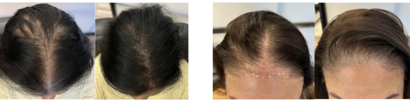 Scalp micropigmentation before and after women and hair loss