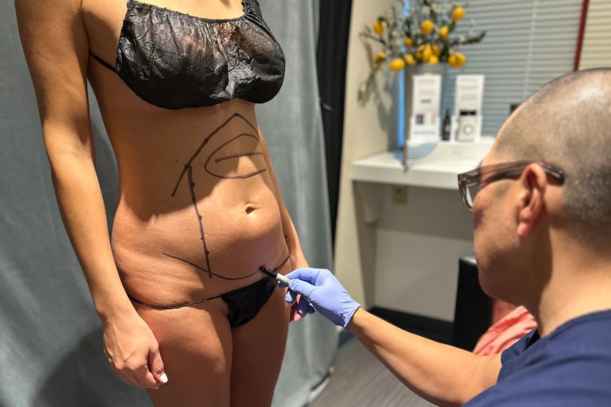 Tummy Tuck for Jawline Contouring