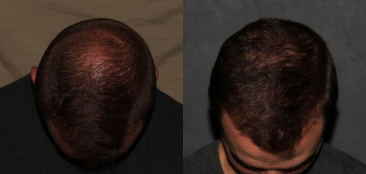 PRP hair restoration before and after