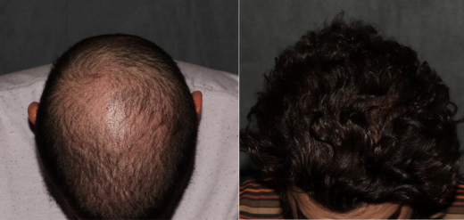 Crown hair restoration