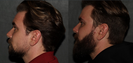 Beard hair transplant