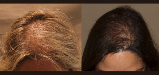 PRP hair restoration in women