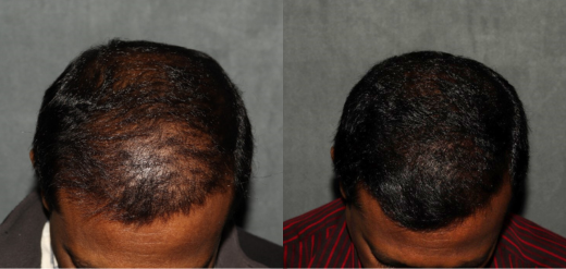 PRP hair restoration before and after front hairline