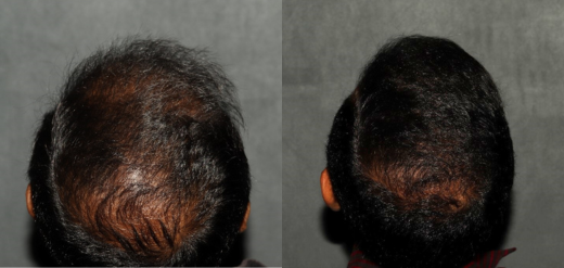 PRP hair restoration before and after Philadelphia