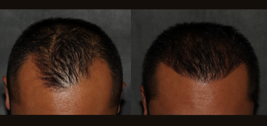 Hair Transplant Before and After Philadelphia