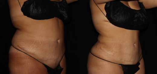 Laser Liposuction Before & After Philadelphia