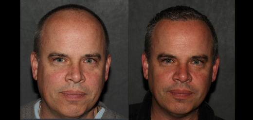 hair transplant before and after Philadelphia