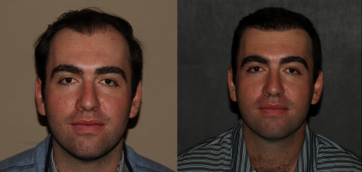 ARTAS iX and NeoGraft hair transplant before and after Philadelphia