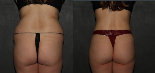 Before and after Lipo 360 and BBL