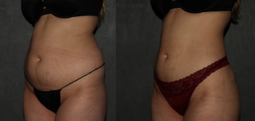Before and after Lipo 360