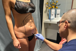 Laser Liposuction vs. Tummy Tuck Philadelphia, PA