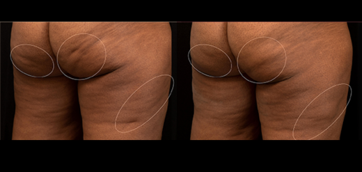 Aveli Cellulite treatment