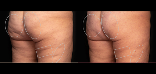 Aveli Cellulite treatment Philadelphia