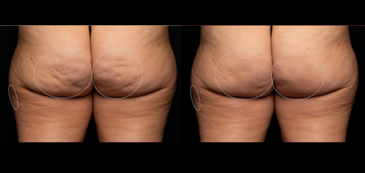 Aveli Cellulite treatment Philadelphia, PA