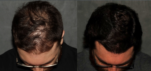 Hair Transplant Philadelphia