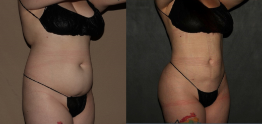 Before and after liposuction Philadelphia