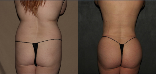 Before and after liposuction Philadelphia