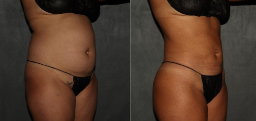 Before and after weight loss and liposuction Philadelphia