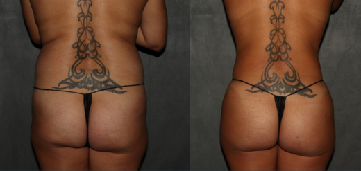 Before and after liposuction Philadelphia