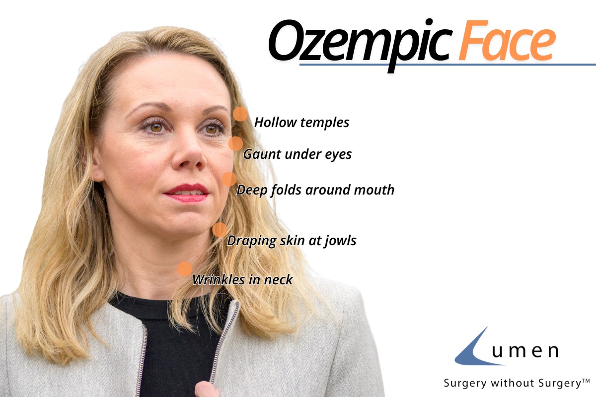 “Ozempic Face” and How to Fix It Lumen Laser Center