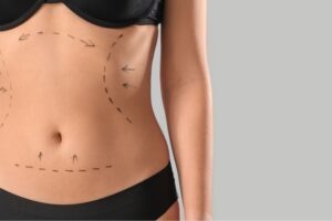 Your Liposuction Journey