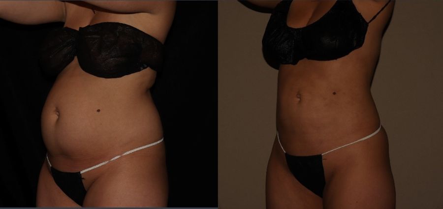 3 month post SmartLipo process
