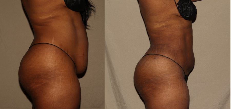 4 month post SmartLipo process