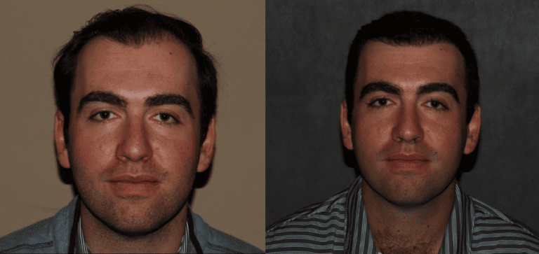 ARTAS iX and NeoGraft hair transplant before and after Philadelphia