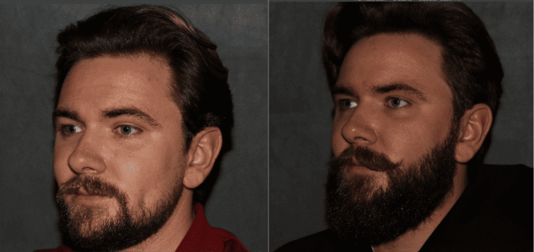 Beard hair transplant Philadelphia after 6 month