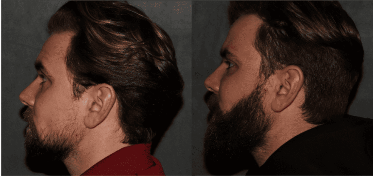 Beard hair transplant Philadelphia after 6 month
