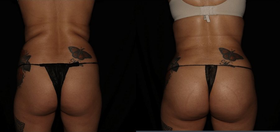 Before and after butt lift surgery in Philadelphia