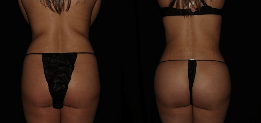 Before and after butt lift surgery