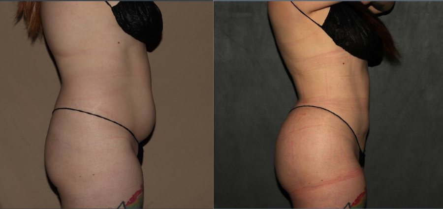 Body shaping and butt lift