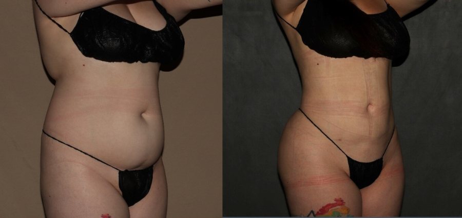 Body shaping and butt lift