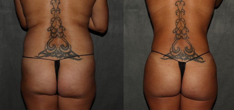 Body shaping and butt lift