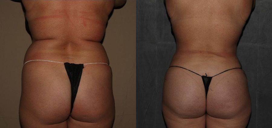 Brazilian Butt Lift Before and After