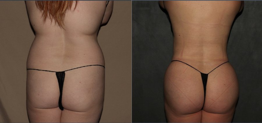 Brazilian Butt Lift Before and After in Philadelphia