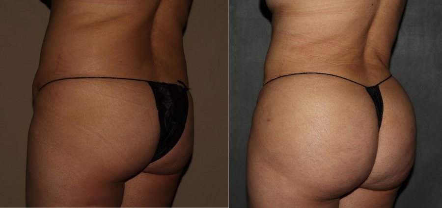 Brazilian Butt Lift Before and After in Philadelphia