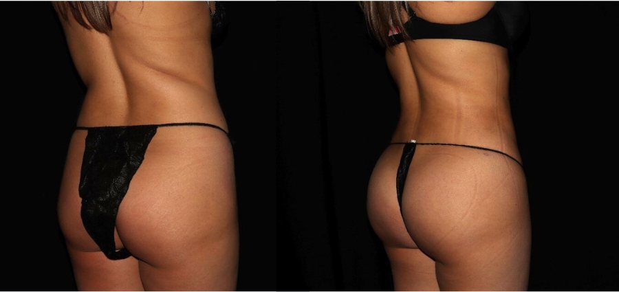 Brazilian Butt Lift Before and After in Philadelphia