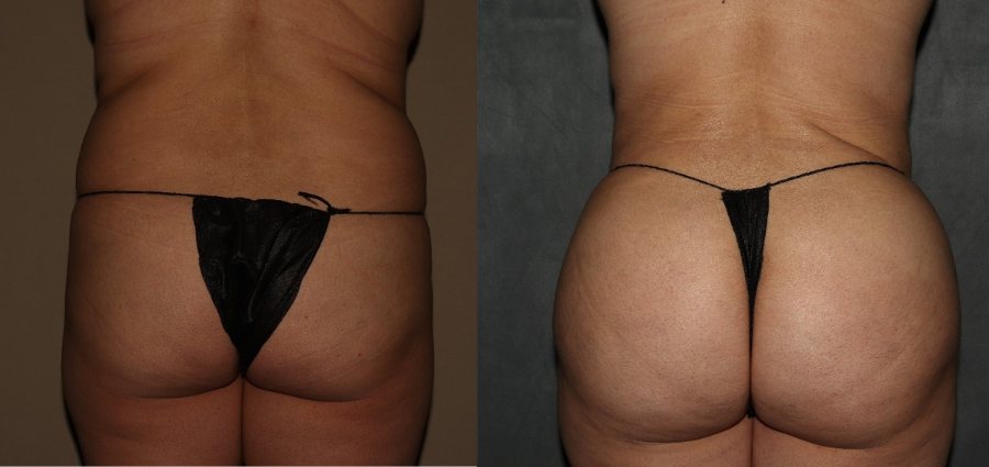 Brazilian Butt Lift Before and After in Philadelphia