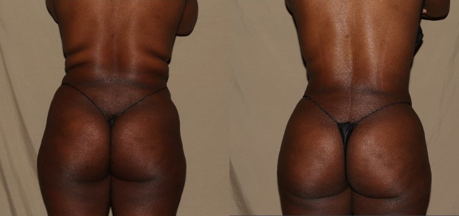 Brazilian Butt Lift Philadelphia