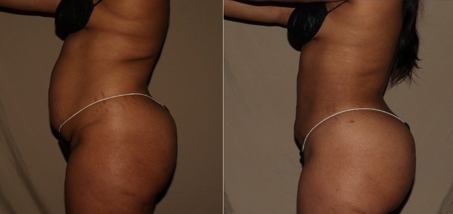 Brazilian Butt Lift Philadelphia