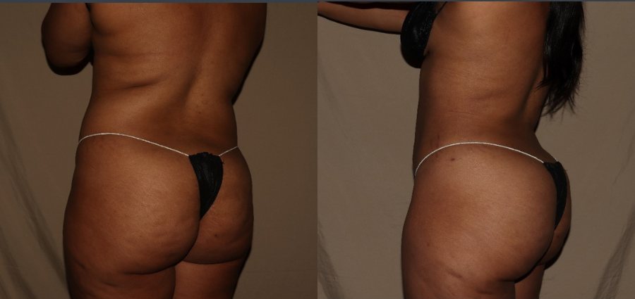 Brazilian Butt Lift one month adter process