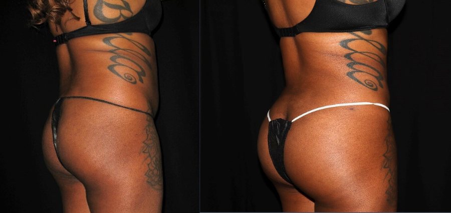 Brazilian Butt Lift process in phily