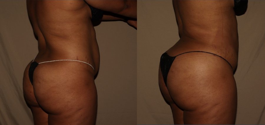 Brazilian Butt Lift process