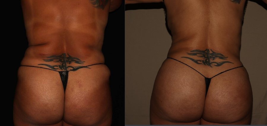Brazilian Butt Lift
