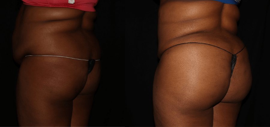 Butt lift surgery