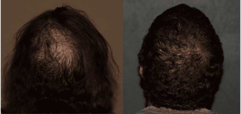 Crown hair restoration after 6 month