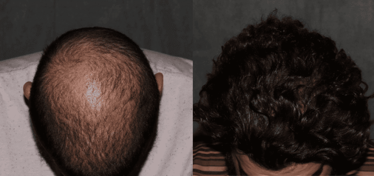 Crown hair transplant Philadelphia after 1 year
