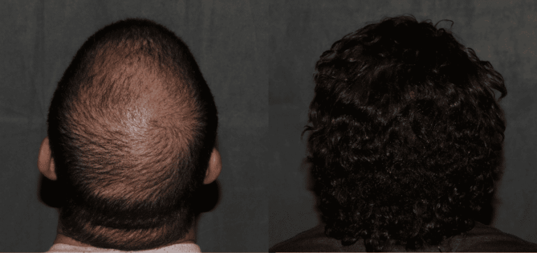 Crown hair transplant after one year